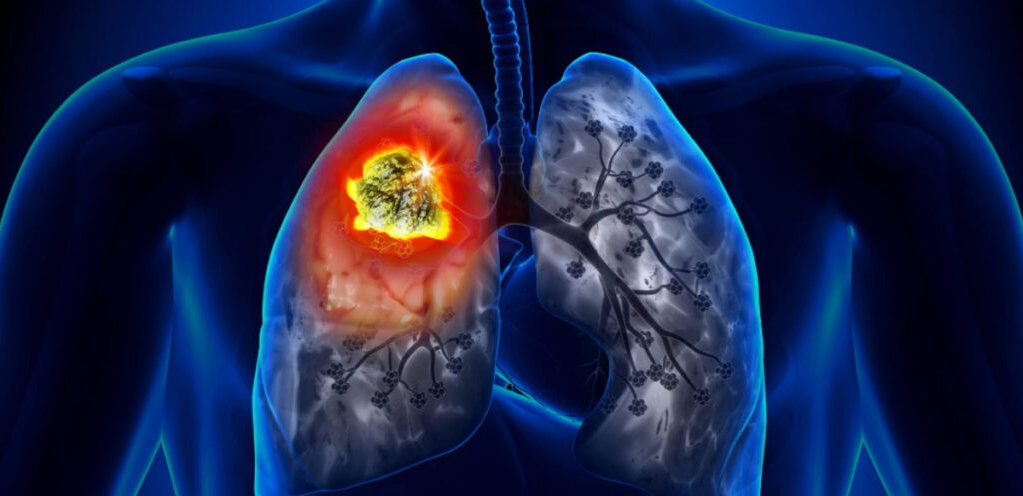 Cáncer de pulmón